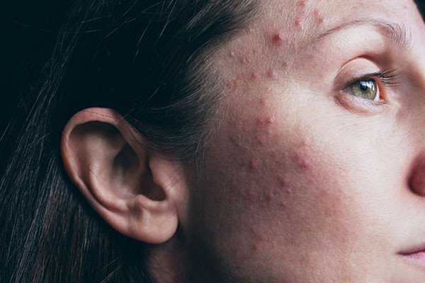 close-up photo of a woman's face showing a serious acne breakout around her eye and down the right side of her face